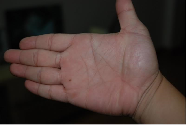 Nốt ruồi phú quý ở lòng bàn tay