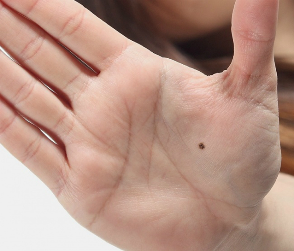 Vị trí nốt ruồi may mắn ở bàn tay