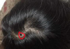 Xem bói vị trí nốt ruồi trên đầu có ý nghĩa gì?