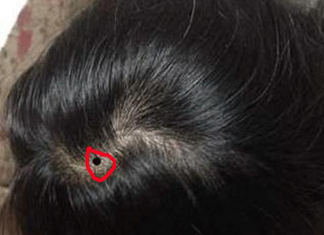 Xem bói vị trí nốt ruồi trên đầu có ý nghĩa gì?