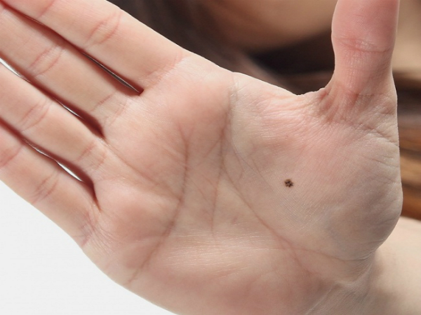 Ý nghĩa của nốt ruồi ở lòng bàn tay nam giới