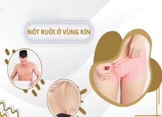Nốt ruồi ở vùng kín nam giới và nữ giới tốt hay xấu