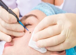 Tẩy nốt ruồi có ảnh hưởng đến tướng số không