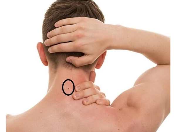 Thế nào được gọi là nốt ruồi sau gáy