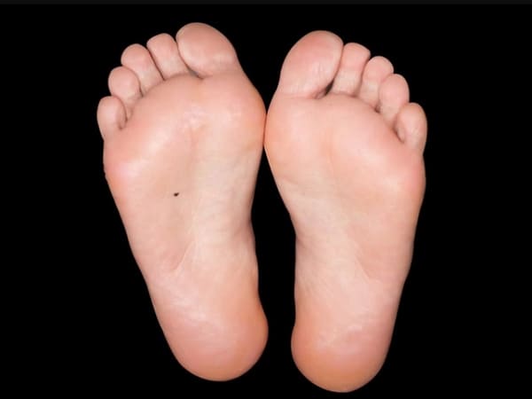 Xem nốt ruồi son ở lòng bàn chân vị trí ngón chân cái