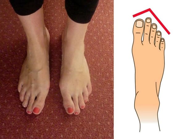 Xem tướng qua các đường chỉ của bàn chân