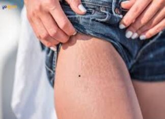 Giải mã nốt ruồi ở đùi tướng số tương lai tốt hay xấu? nốt ruồi ở đùi