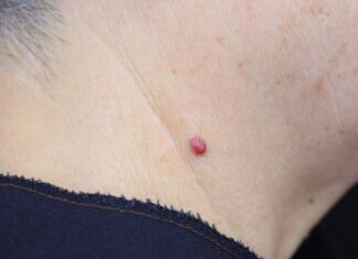 Xuất hiện nốt ruồi son ở cổ nam và nữ giới ý nghĩa gì? Xuất hiện nốt ruồi son ở cổ nam và nữ giới ý nghĩa gì?